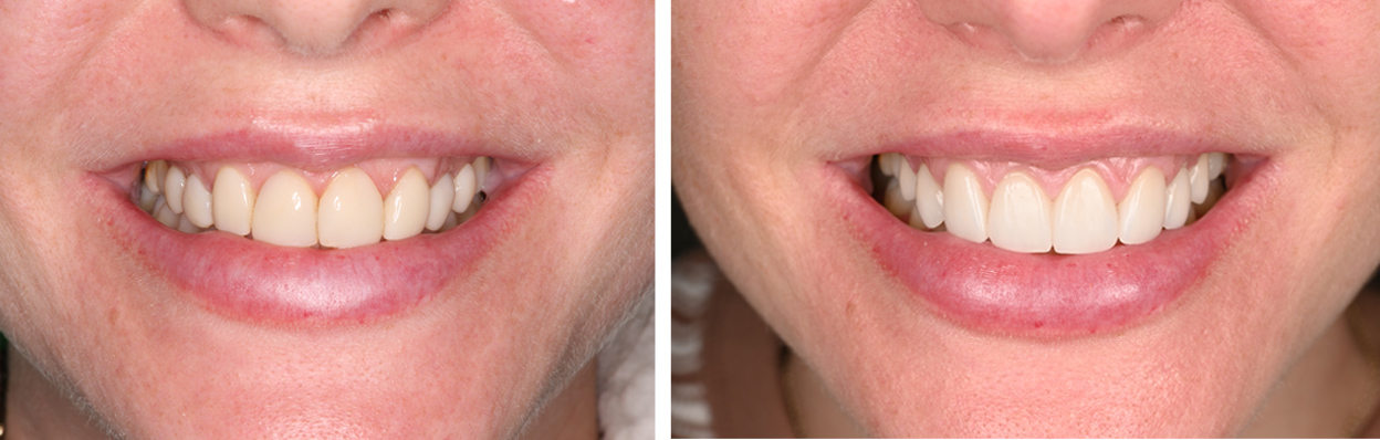 After treatment 1