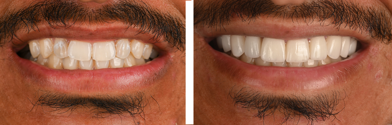 After treatment 2
